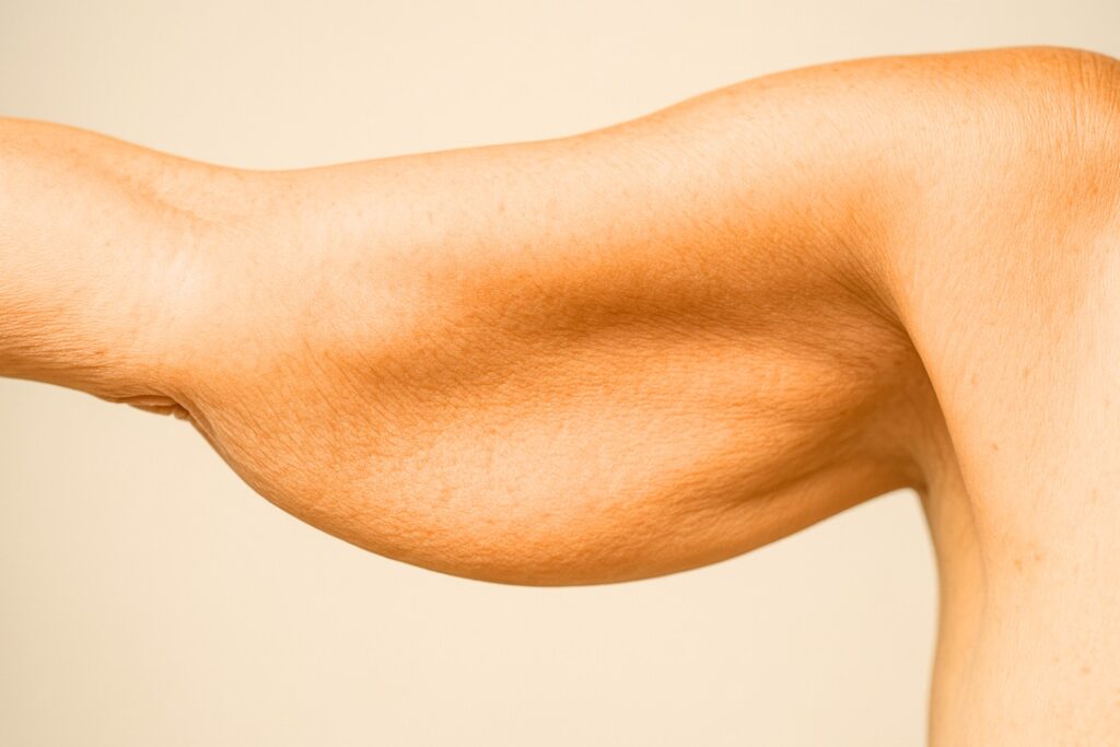 Get Rid Of Flabby Skin Over 50