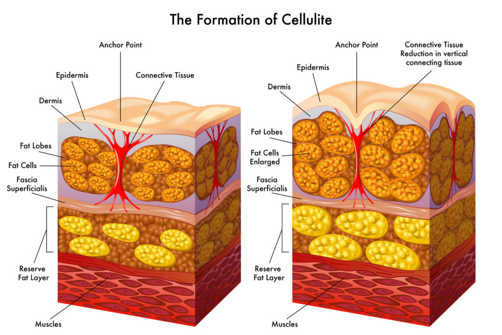 Get Rid Of Cellulite