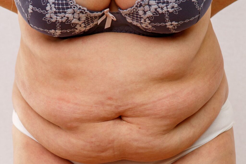 Why Belly Fat is Dangerous for Women Over 50 